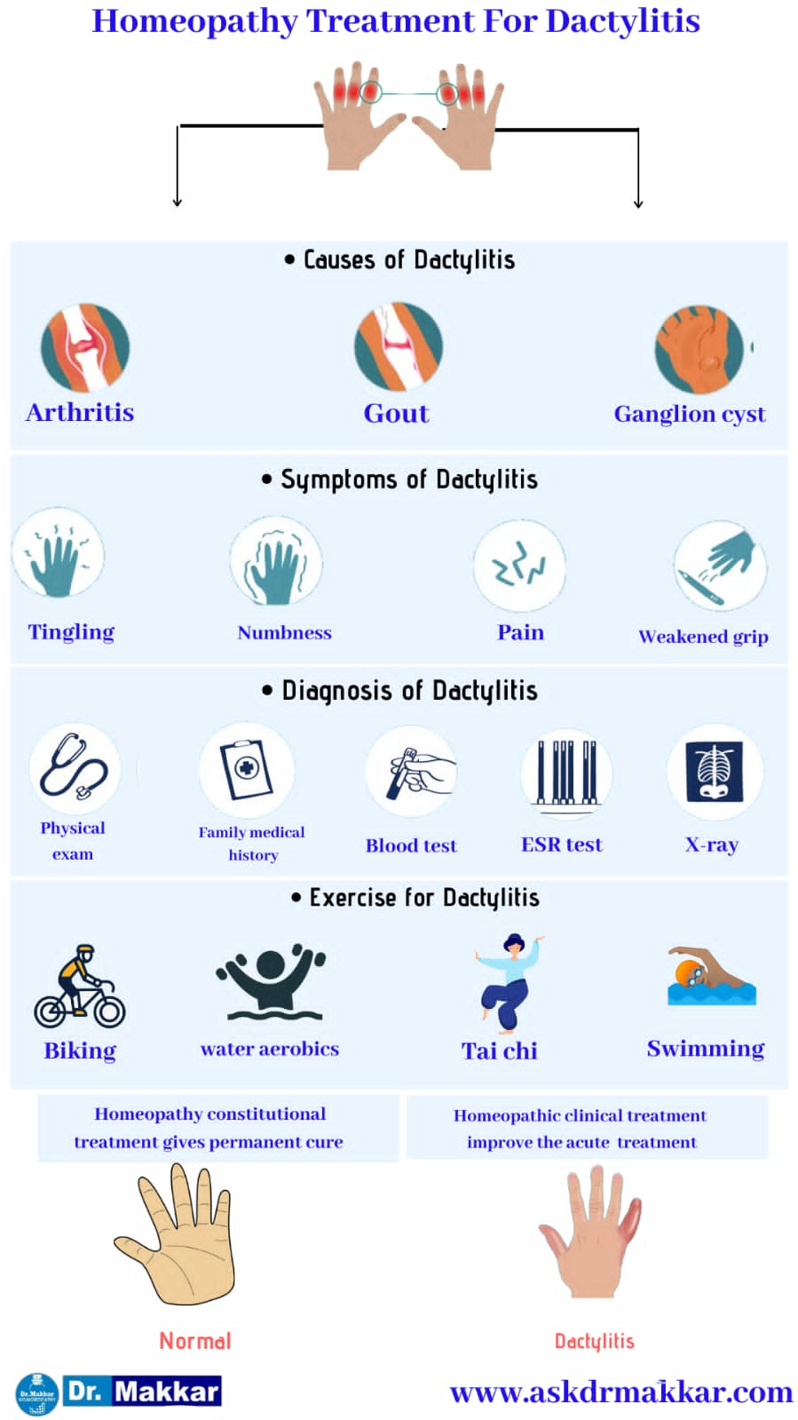 Dactylitis || Sausage Fingers || Digit Swelling Of Fingers & Toes ...